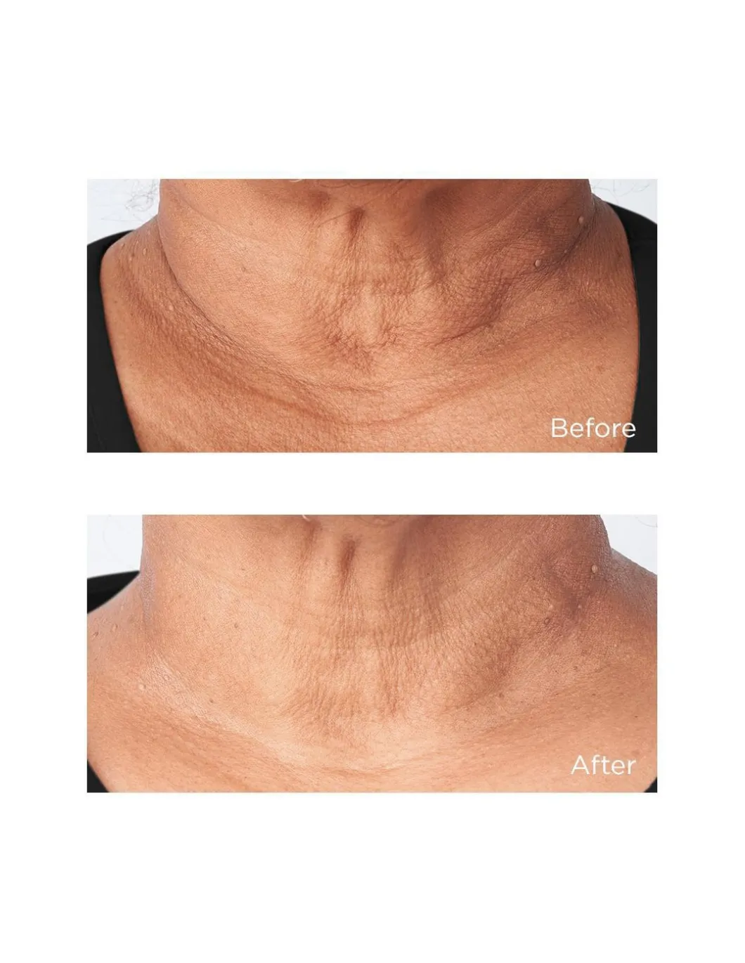 Cold Plasma Plus+ Sub-D/Neck | Perricone